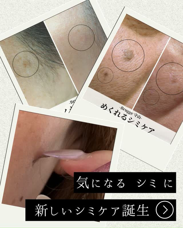 男女のシミ悩みは、滋賀県守山Bruggeへ✨